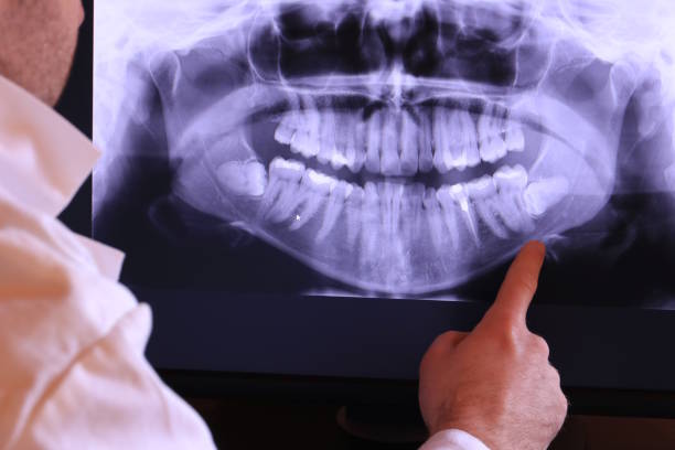 Emergency Dental Filling Replacement in CO